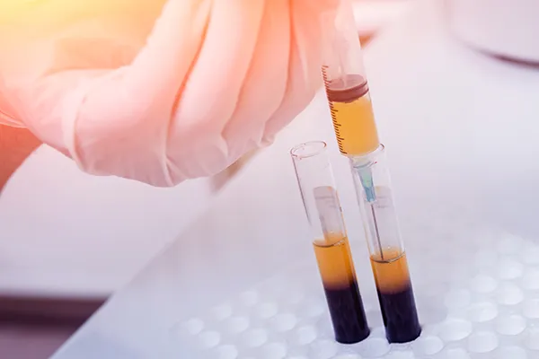 about-prp-orthpedics PRP orthopedic syringe preparation from tubes of platelet rich plasma
